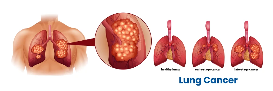 lung-cancer