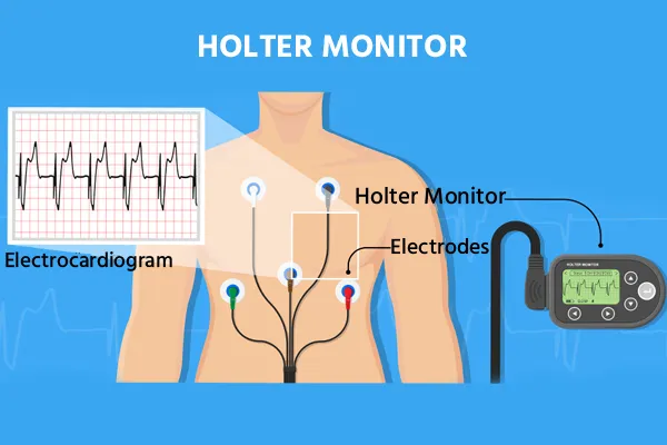 Holter Monitoring Holter Monitoring
