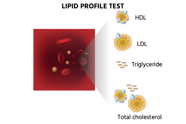 Lipid Profile Lipid Profile