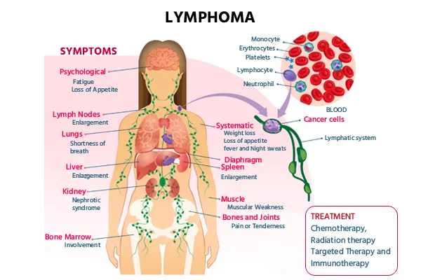 Lymphoma Panel Lymphoma test