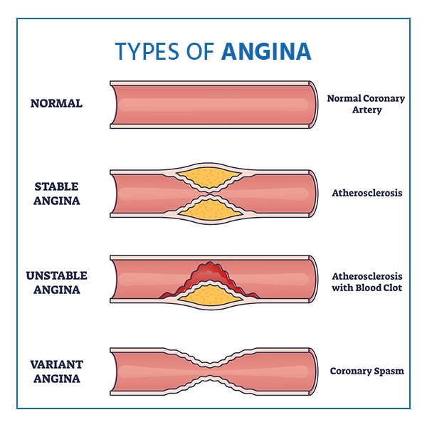 Types of Angina