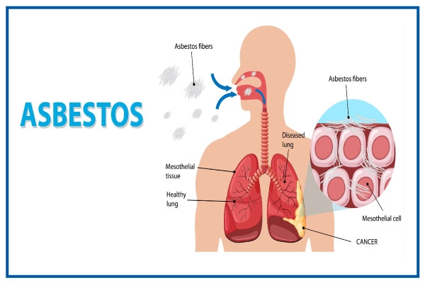 Asbestosis Disease