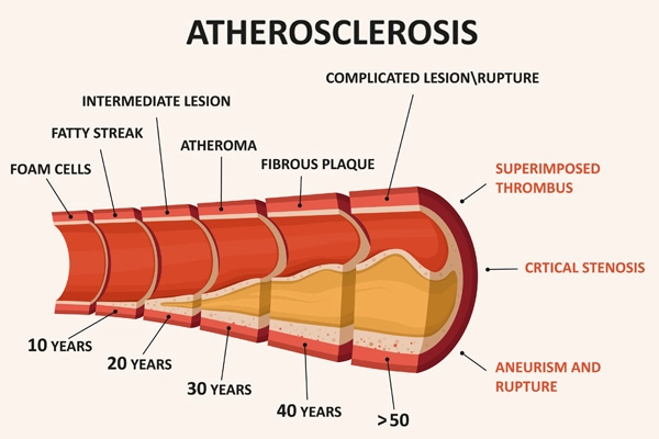 atherosclerosis