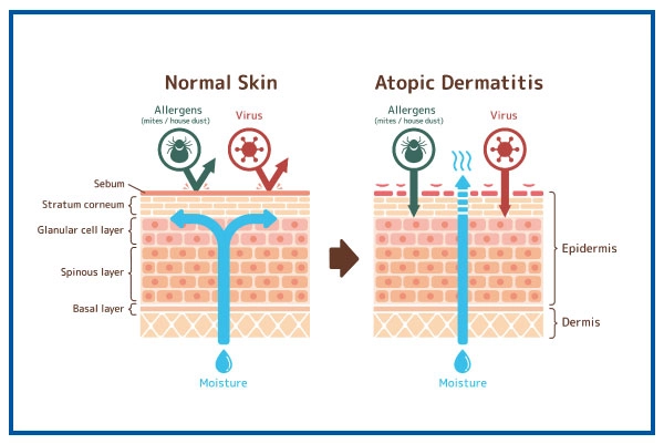 Atopic Dermatitis