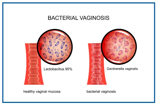 Bacterial Vaginosis