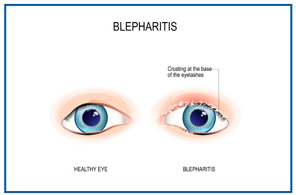 Blepharitis