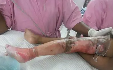 burns-injury-1