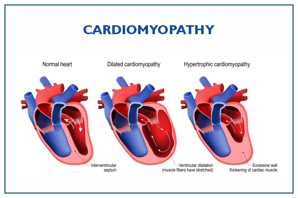 Cardiomyopathy