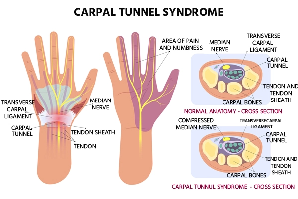 Carpal Tunnel Syndrome
