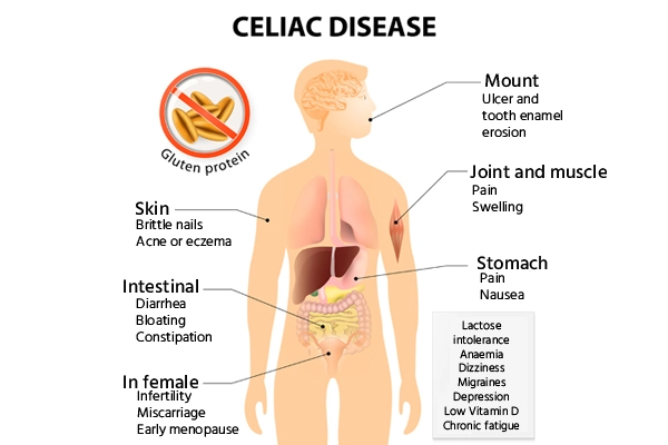 celiac disease symptoms
