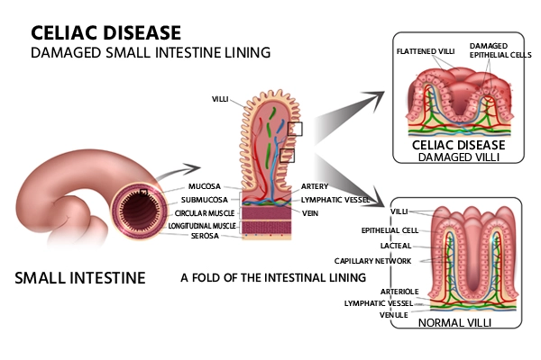 celiac disease