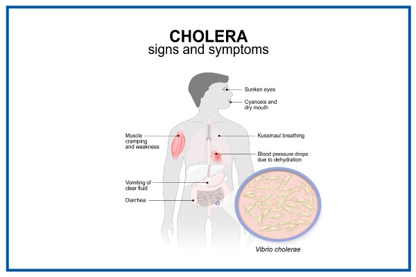 Cholera Disease