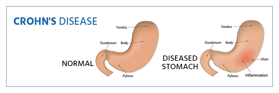 Crohn's Disease