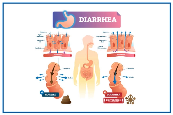 Diarrhea