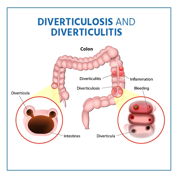 Diverticulosis