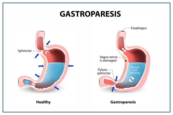 gastroparesis