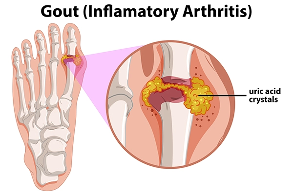 Gout Disease