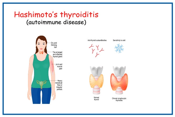 Hashimoto Disease Hashimoto Disease