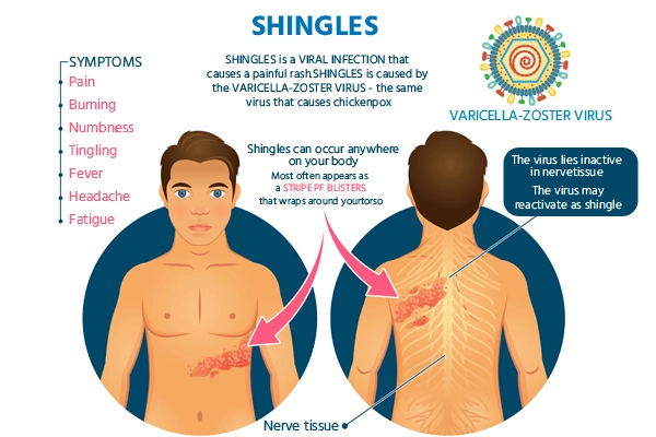Herpes Zoster Symptoms