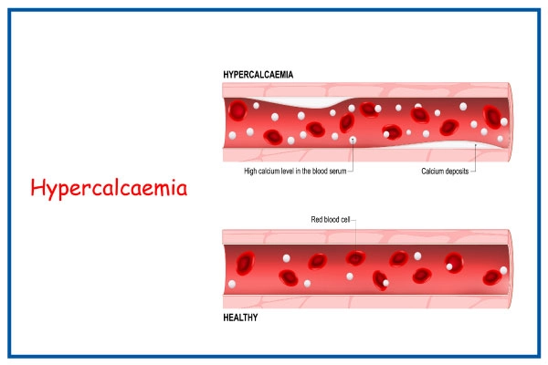Hypercalcemia