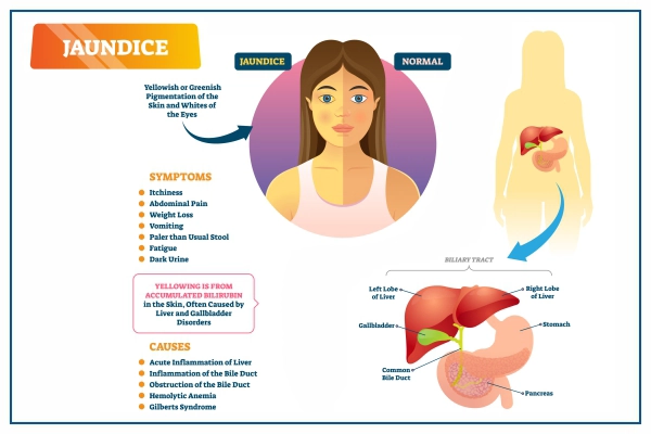 jaundice overview