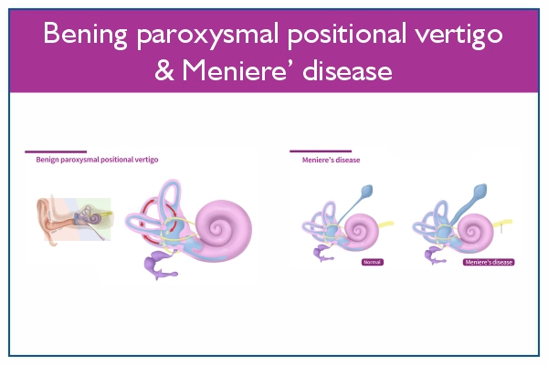 Meniere's Disease