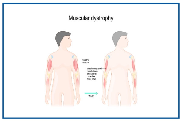 Muscular Dystrophy