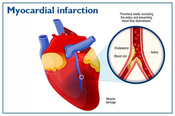 Myocardial Infarction