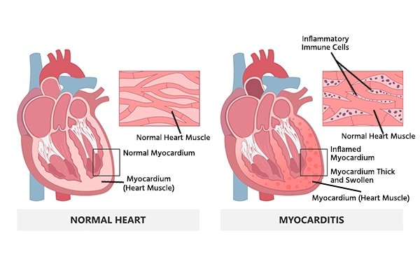 Myocarditis
