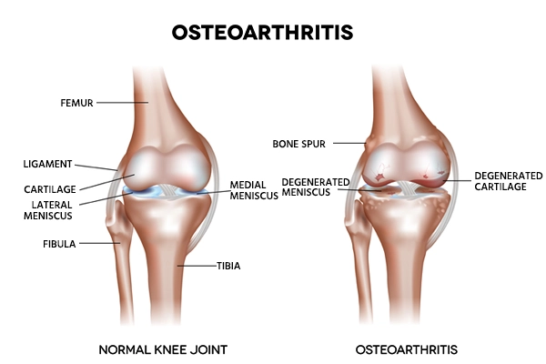 Osteoarthritis