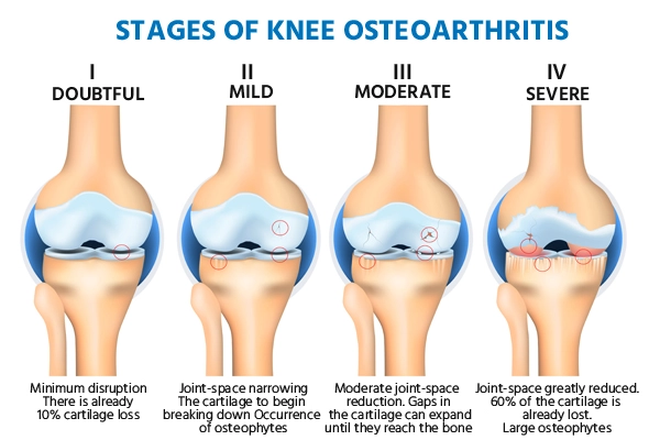 Stages of Knee Osteoarthritis