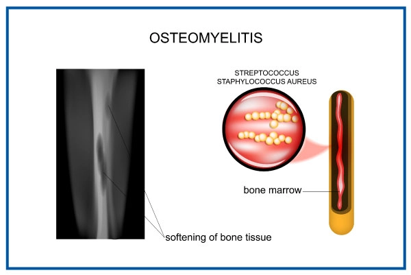 Osteomyelitis