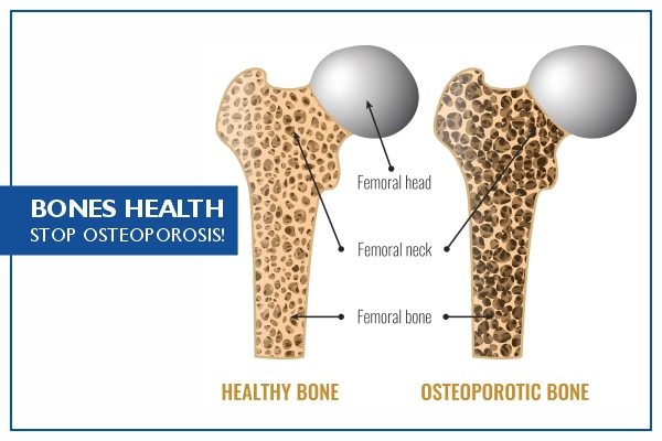 Osteopenia