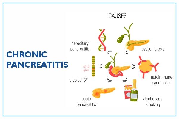 Pancreatic Cancer Causes