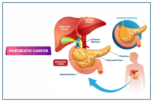 Pancreatic Cancer