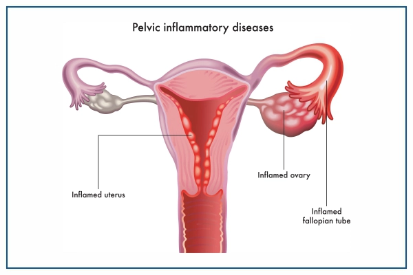 Pelvic Inflammatory Disease