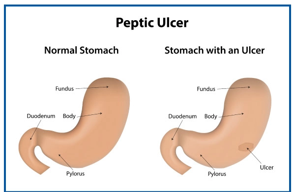 Peptic Ulcer