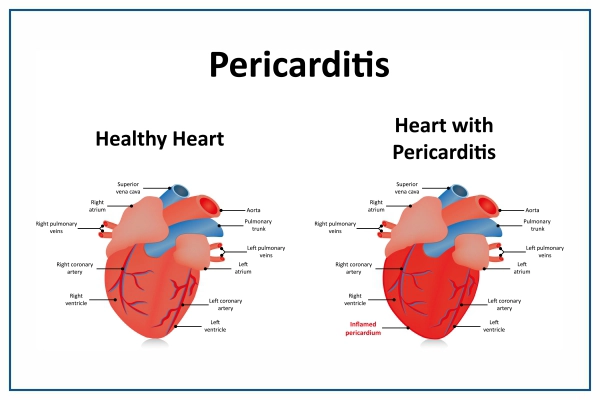 Pericarditis