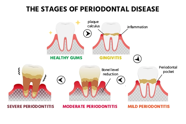 Stages of Periodontitis