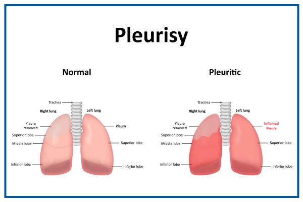 Pleurisy
