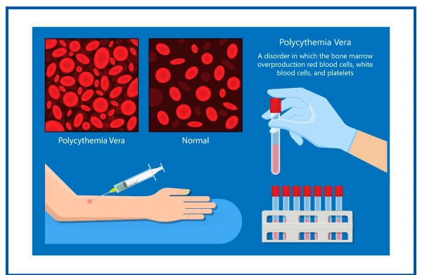 Polycythemia