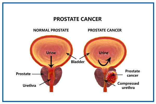 Prostate Cancer