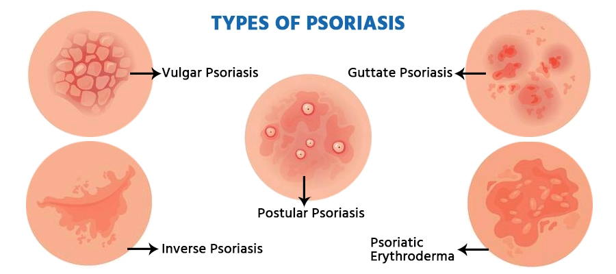 types of psoriasis