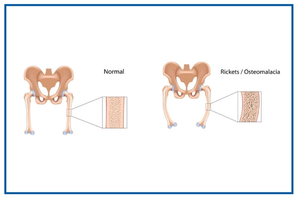 rickets