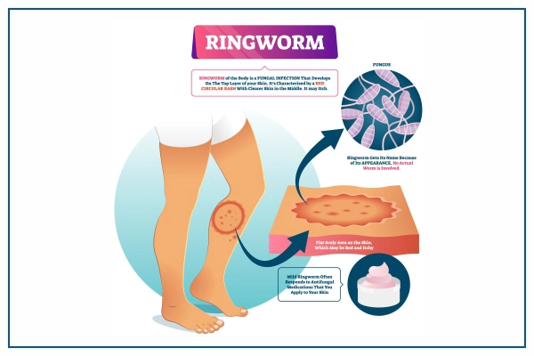 ringworm-infection