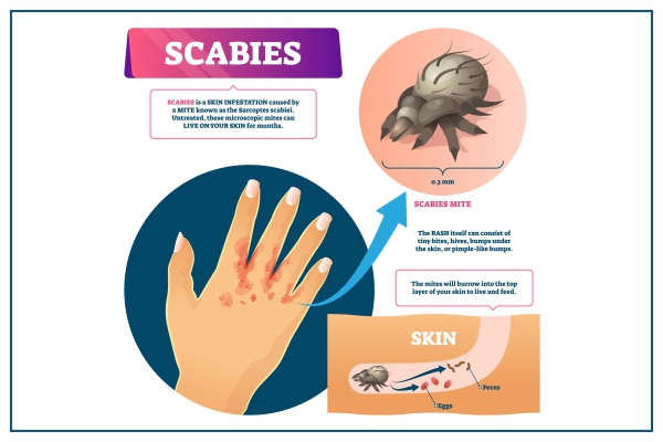 scabies