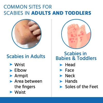 scabies-1 scabies-1