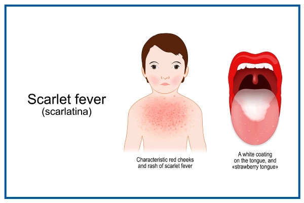 Scarlet Fever Scarlet Fever