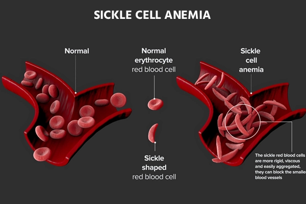Sickle Cell Anemia