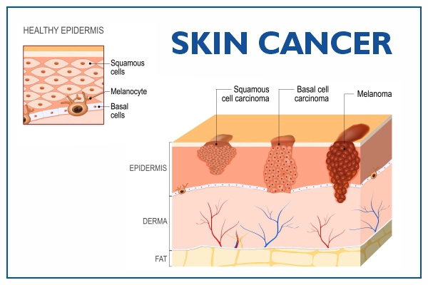 Skin Cancer